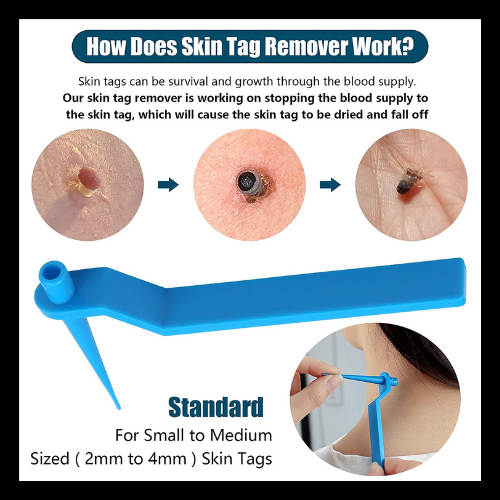 Skin Tags Remover